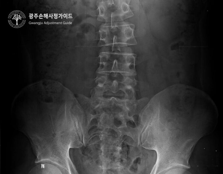 척추압박골절 보험금 (후유장해) 보상받기 :: 광주손해사정 가이드 장한서 손해사정사