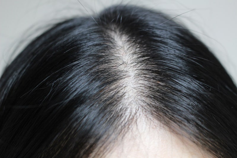 비듬 없애는 방법 홈케어로 해결해요 6