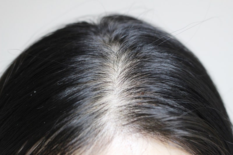 비듬 없애는 방법 홈케어로 해결해요 5