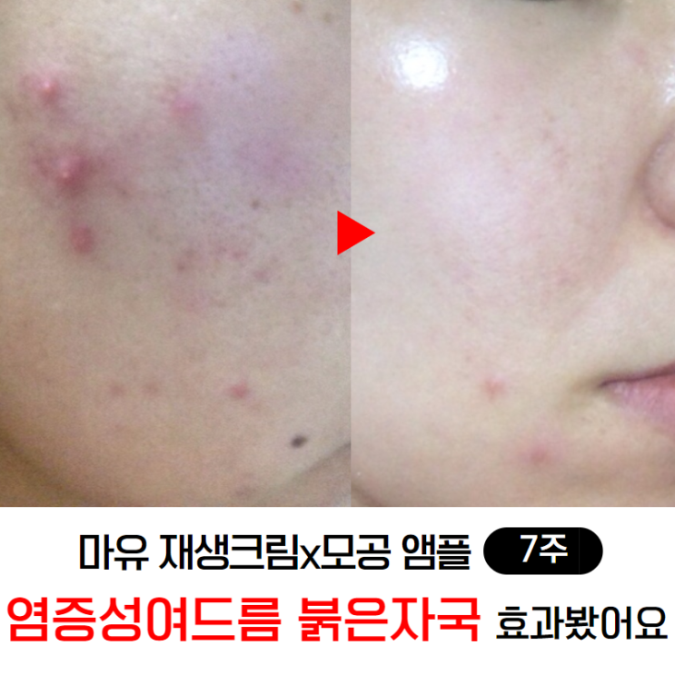  염증성여드름 붉은자국 마유크림 효과有