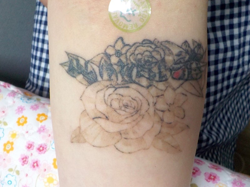 타투 지우는 장소 치료 보장제로 결과 만족도 up 8