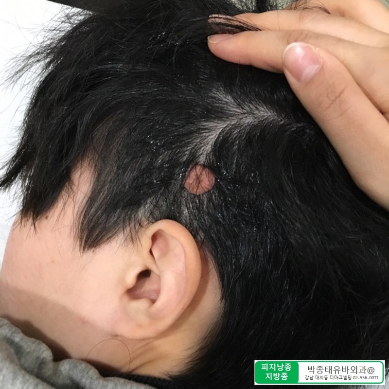 Dr.Park] 머리 혹 그냥 두지 마세요.. 두피에 발생한 섬유종 제거 수술 : 네이버 블로그
