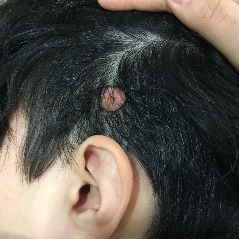 Dr.Park] 머리 혹 그냥 두지 마세요.. 두피에 발생한 섬유종 제거 수술 : 네이버 블로그