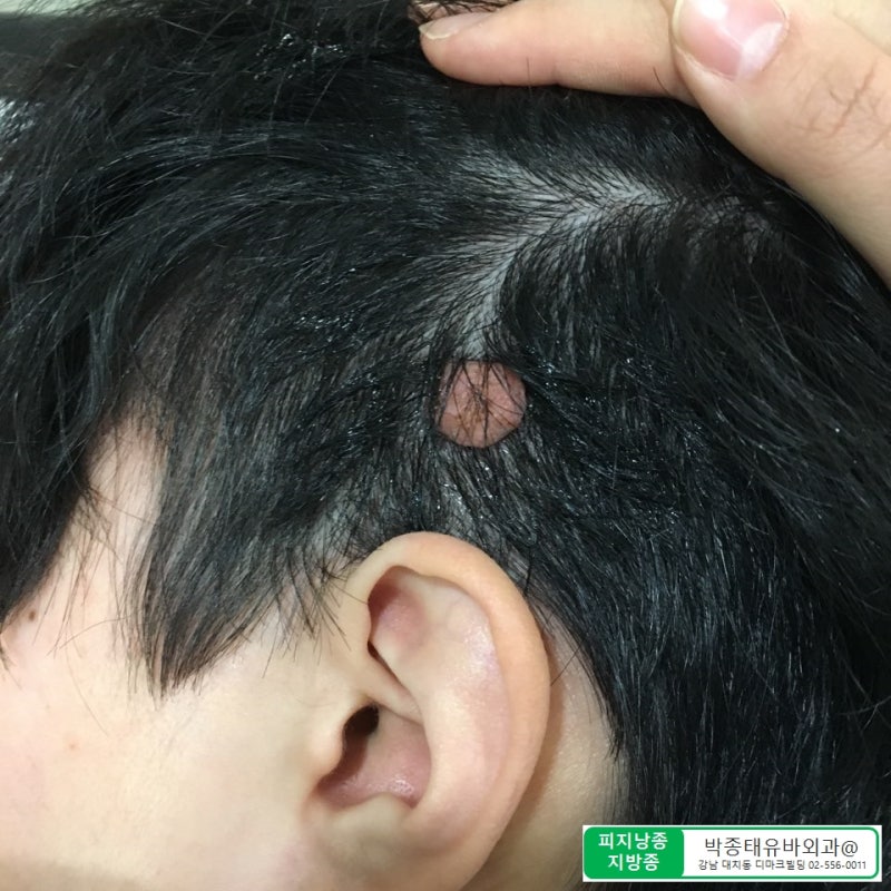 두피(후두부), 돌출혹, 피지낭종수술 7
