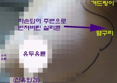피막외파손 보형물 실리콘이 겨드랑이림프절로 퍼진 경우, 가슴성형재수술