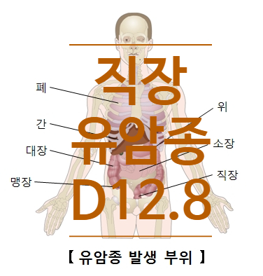  D128 직장양성종양, 유암종(Carcinoid tumor)