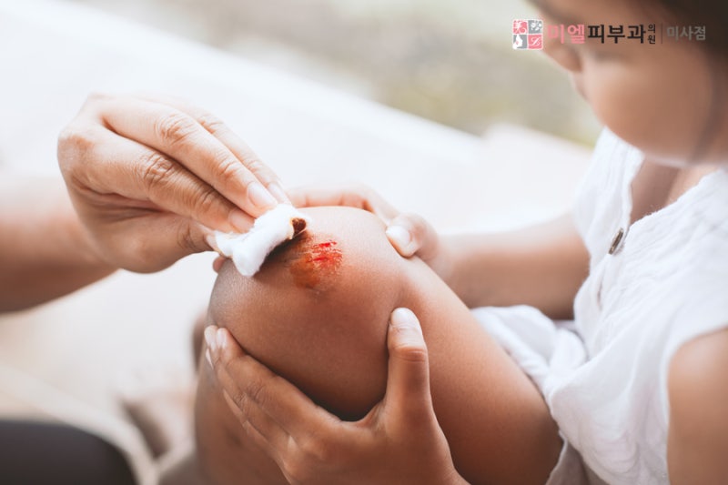 흉터 예방을 위한 여드름 재생크림 추천 흉터 예방을 위한 여드름 재생크림 추천