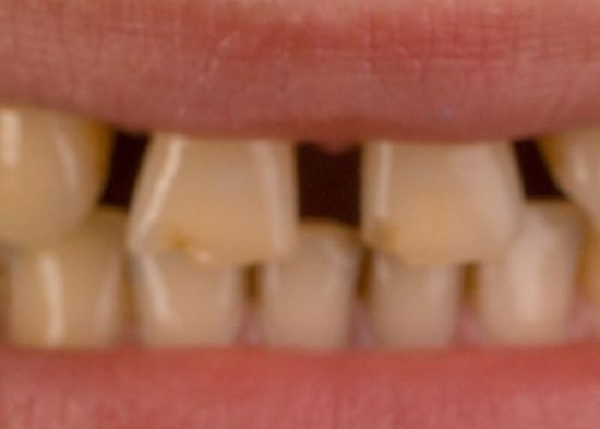 치아미백 치료 이후에 터치업으로 관리가 필요한 이유?