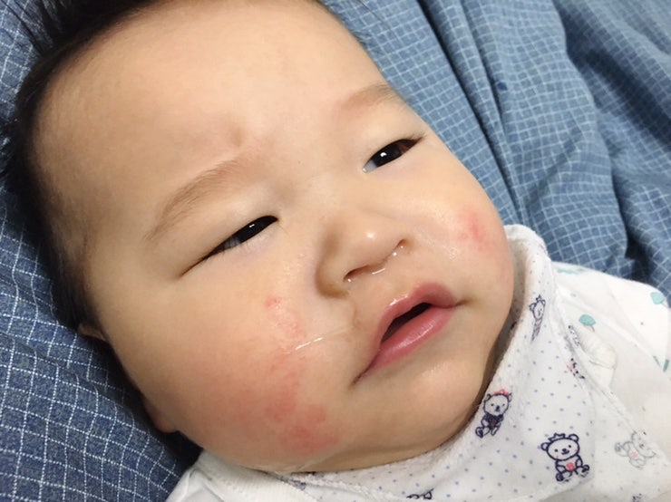 아기 유아 코감기 목감기 가래 끈적이는 콧물(콧물, 사진 있음) 6