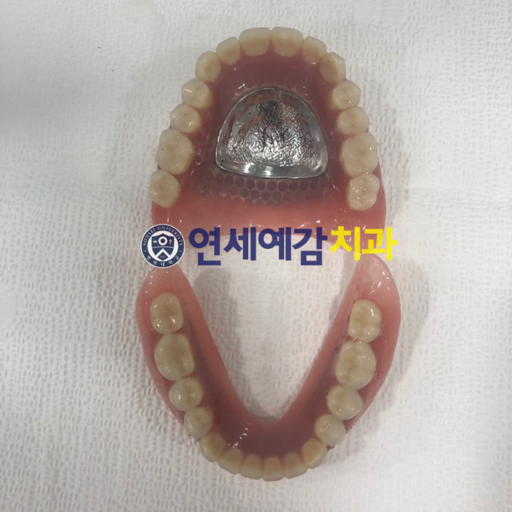  서울 틀니제작, 틀니치료 실제 예입니다. 시청역<연세예감치과>