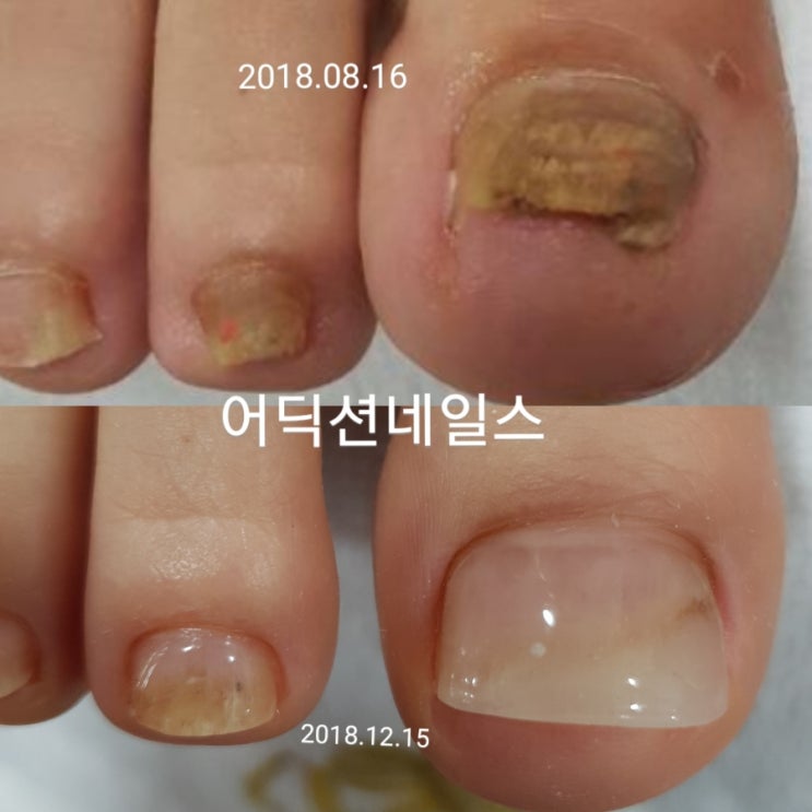  발톱무좀패디큐어