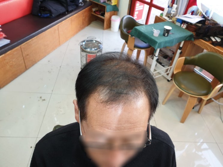  춘천가발 김호증모 남성탈모 원인과증상 탈모치료방법 및 이은주헤어살롱의 비책!! "남자맞춤가발 본뜨기"