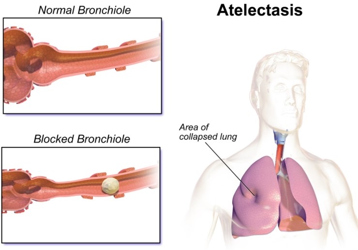 atelectasis : 네이버 블로그 atelectasis : 네이버 블로그