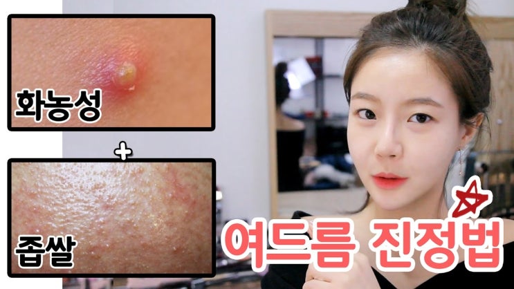 여드름 흉터 없애는 법 및 여드름 진정법!! 흉터 제품과 치료에 대한 설명,각질,건선,가려움증,뾰루지,샴푸 여드름 흉터 없애는 법 및 여드름 진정법!! 흉터 제품과 치료에 대한 설명,각질,건선,가려움증,뾰루지,샴푸