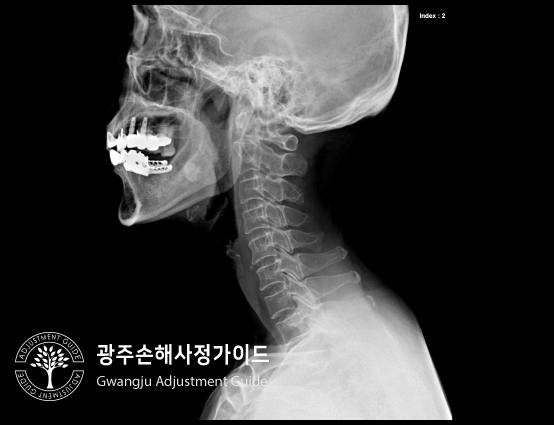 척추압박골절 후유장해 보상 (보험금 분쟁 대처) : 광주손해사정 가이드 장한서 손해사정사
