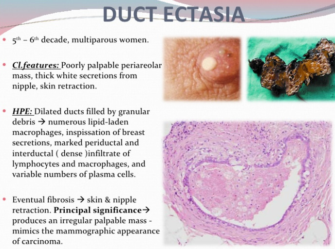 Intraductal papilloma duct ectasia
