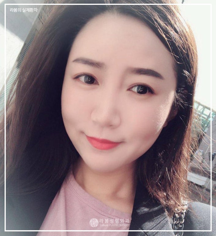 V라인 리프팅 안면거상잘하는곳 라봄성형외과 : 네이버 블로그