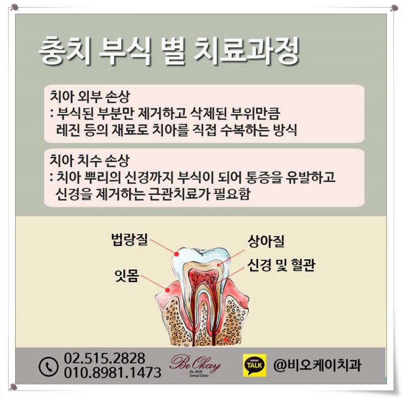 치아레진비용 초기치료가 중요합니다 2