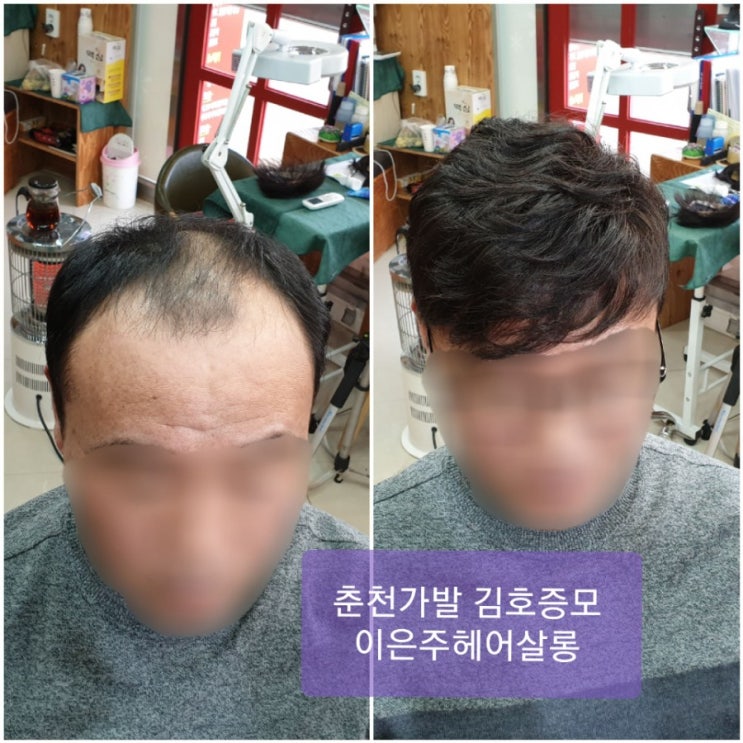  춘천가발 김호증모 고정식가발