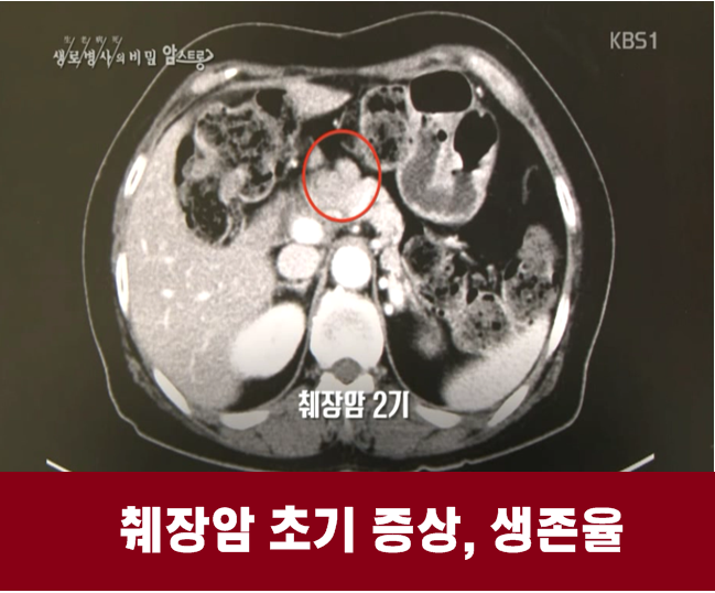  췌장암 초기증상, 생존율