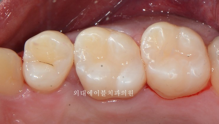 치과의사의 어금니 충치치료(레진치료)... ㅋㅋ