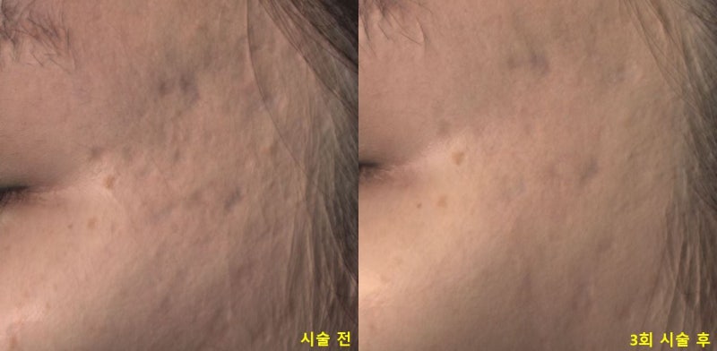 관자놀이 여드름 제거 후기