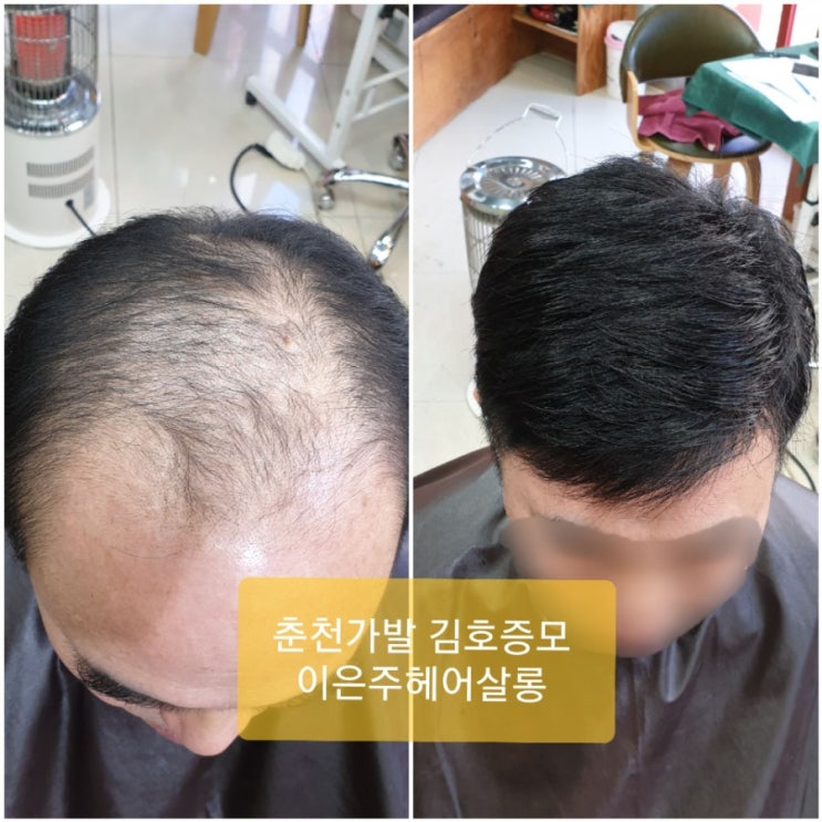  춘천가발 김호증모 남자맞춤가발 피팅합니다~^^