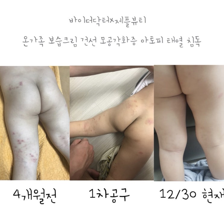  바이더닥터 X 제플뷰티 2차공구 OPEN / 재그의기적을 믿으세요. 온가족 건선/ 모공각화증 / 아토피 / 태열 / 보습 바디크림