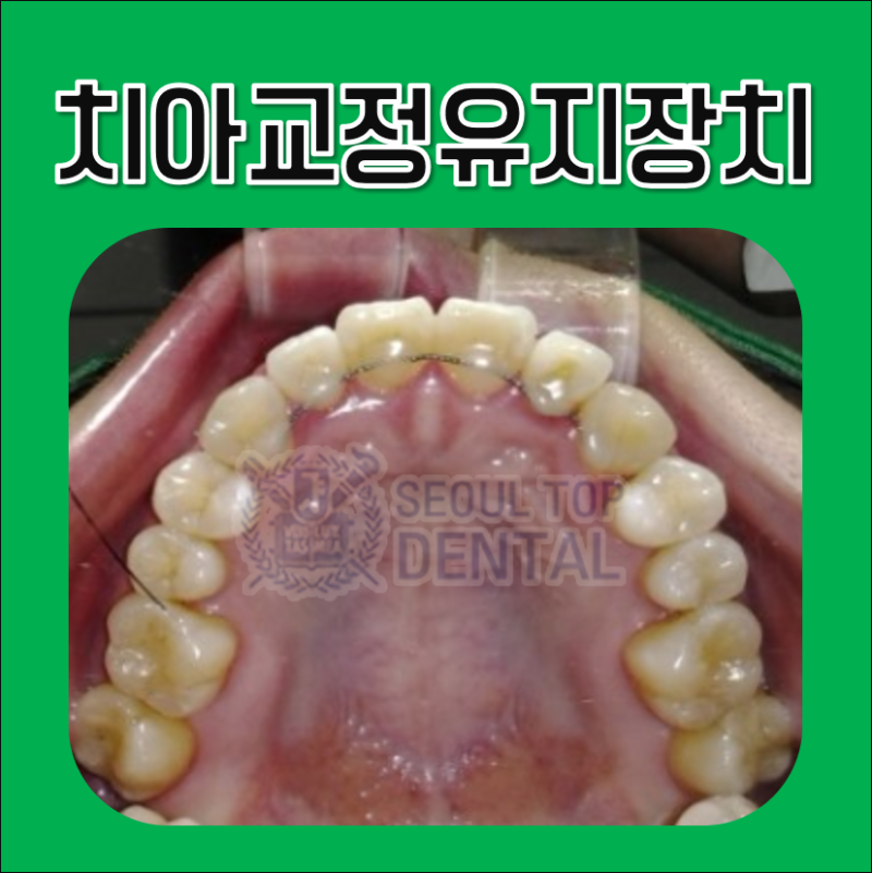 치아교정유지장치 안 하면 안 되나요? : 네이버 블로그 치아교정유지장치 안 하면 안 되나요? : 네이버 블로그