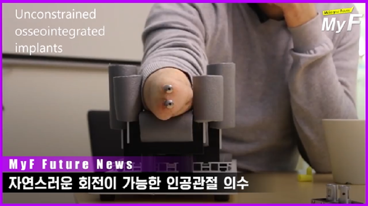  회전형 인공관절 의수