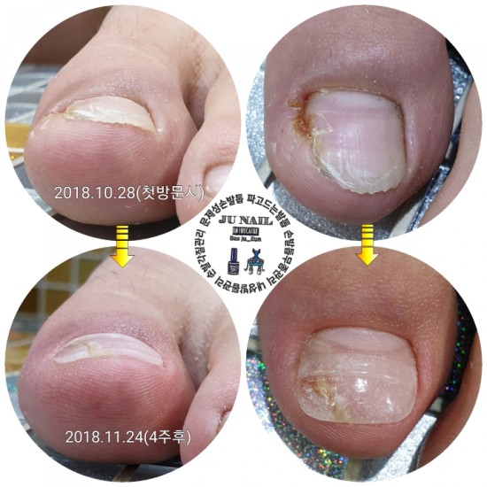 파고드는발톱수술3개월후염증때문에너무고통스럽습니다/분당용인수원수지보정동백죽전동/주네일/문제성손발톱전문네일샵 파고드는발톱수술3개월후염증때문에너무고통스럽습니다/분당용인수원수지보정동백죽전동/주네일/문제성손발톱전문네일샵