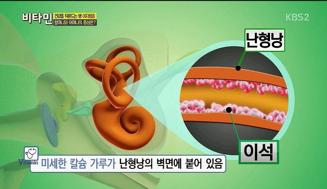 이유 없이 찾아오는 이석증과 청력의 관계는? 괴정보청기. 표가네 보청기. 독일 보청기이석증 어지러워이비인후과 대학병원 난청이명 노화 골밀도 검사 골다공증 2