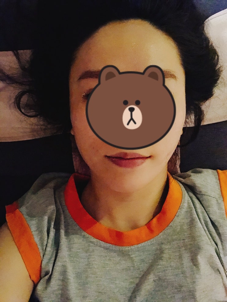  [여드름흉터/패인흉터치료] 울퉁불퉁한 얼굴 흉터 치료 후기 @압구정