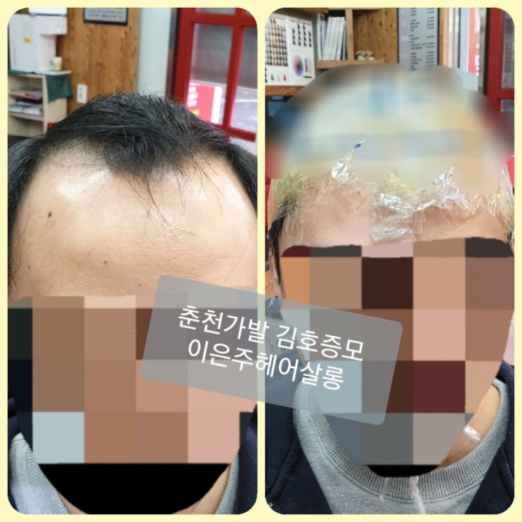  서민갑부 청년가발편 보시고 오늘도 20대 청년 가발 본뜨기~ 춘천가발 김호증모 이은주헤어살롱 입니다^^