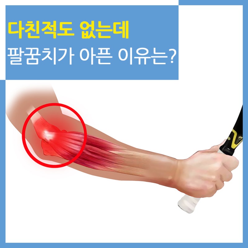 테니스엘보, 골프엘보는 치료가 어려운 난치성 질환이다? 관절 전문병원 CM병원