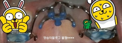  [교정d+27] 세번째 매복사랑니 발치 + 입천장 스크류 장치 달기 (feat. MCPP)