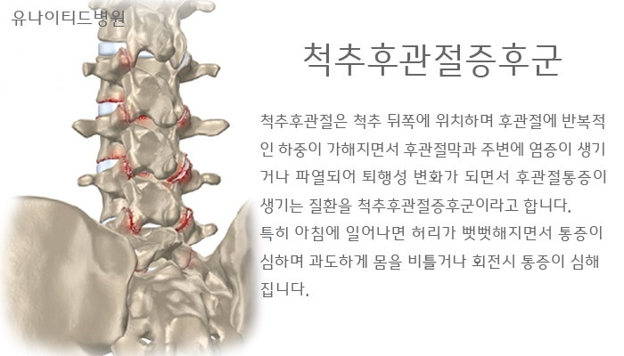 척추후관절증후군? 전문병원이 말하는 1가지 핵심 7