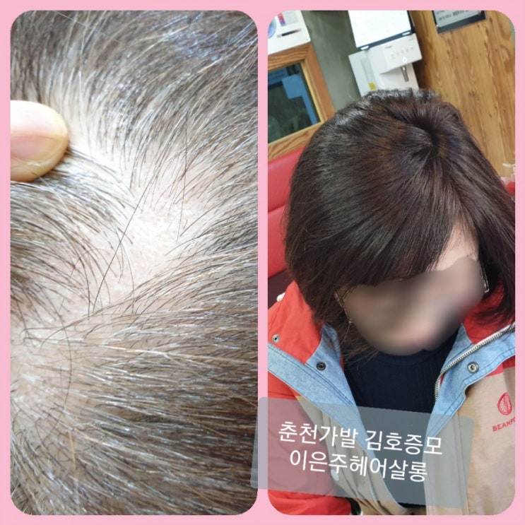  탈모에 흰머리까지 두피가 훤히 비어보일때 부분탑가발로 자신감을 찾아보세요~ 춘천가발 김호증모 이은주헤어살롱 입니다~^^