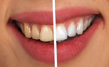 치아미백 치료 횟수는 몇번이 적절한가요?