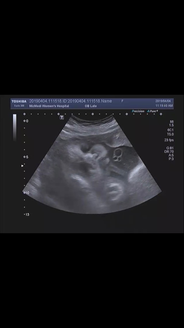 임신 32주 정기검진
