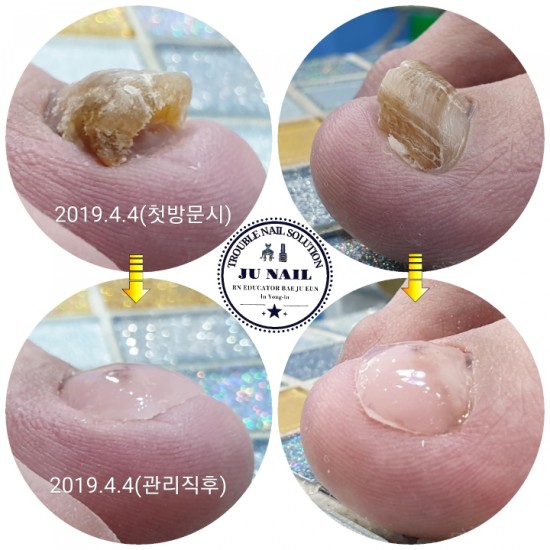 고등학교때 생긴 무좀발톱 당일관리하고 가셨어요~/분당용인수원수지보정동백죽전동/주네일/무좀파고드는발톱전문네일샵 고등학교때 생긴 무좀발톱 당일관리하고 가셨어요~/분당용인수원수지보정동백죽전동/주네일/무좀파고드는발톱전문네일샵