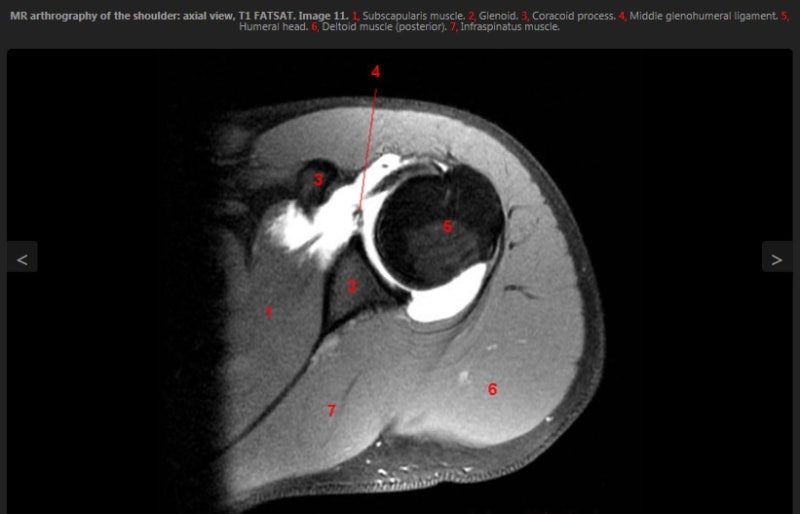 MR Arthrogram(관절조영 MRI검사) : 네이버 블로그