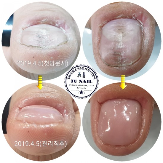 엄지손톱이 울퉁불퉁해지는 이유는 뭘까요?/분당용인수원수지보정동백죽전동/주네일/무좀파고드는발톱전문네일샵 엄지손톱이 울퉁불퉁해지는 이유는 뭘까요?/분당용인수원수지보정동백죽전동/주네일/무좀파고드는발톱전문네일샵