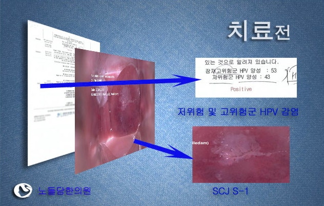 자궁경부이형성증 증상의 근본 원인을 해결하는 면역치료 5