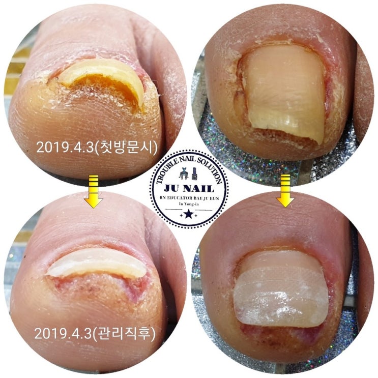 파고드는염증발톱 병원추천으로 수술없이 관리했어요/분당용인수원수지보정동백죽전동/주네일/무좀파고드는발톱전문네일샵