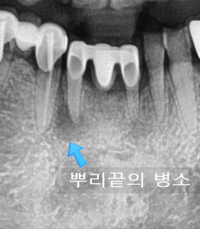  신경치료 후 통증 해결방법 / 신경치료 잘하는 법에 대해 알아봅시다.