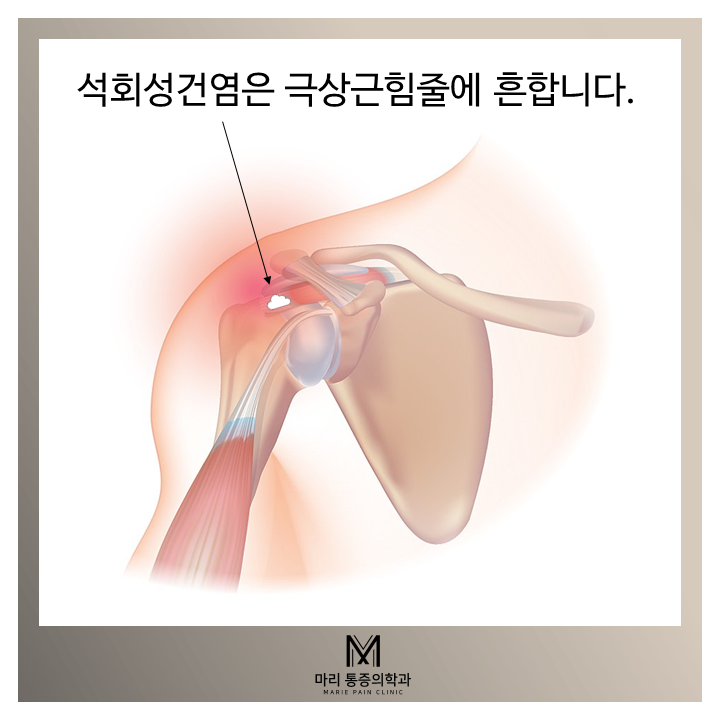  어깨의 석회성 힘줄염