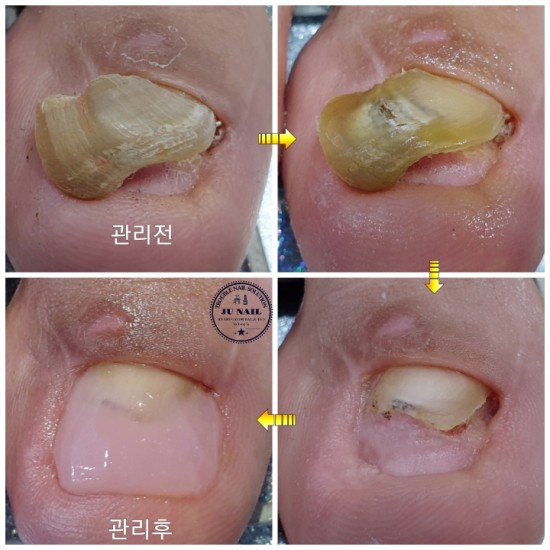 군대에서 시작된 발톱무좀 방치하였더니 이렇게 변형되었습니다./분당용인수원수지보정동백죽전동/주네일/무좀파고드는발톱전문네일샵 군대에서 시작된 발톱무좀 방치하였더니 이렇게 변형되었습니다./분당용인수원수지보정동백죽전동/주네일/무좀파고드는발톱전문네일샵