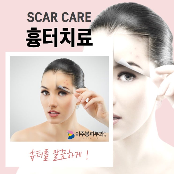  수원이주봉피부과 , 흉터치료 !