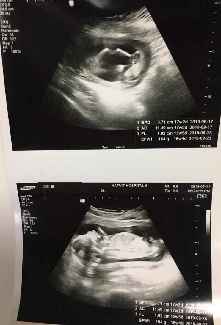  2차 기형아 검사/16주 성별 구분 초음파/난황위치에 따른 성별구분/임산부영양제/임신 16주-임신19주 기록